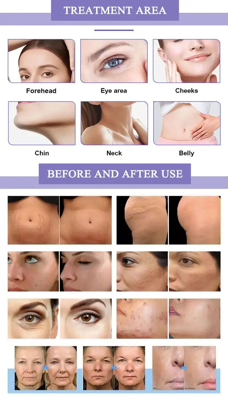 china rf microneedling machine china rf microneedling machine