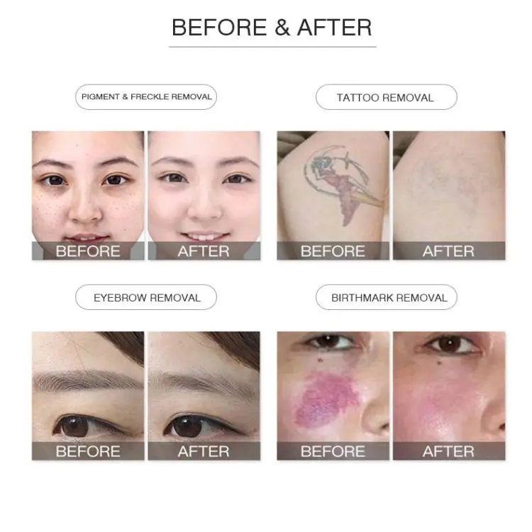 wholesale nd yag q switched 532 nm 1064 nm laser wholesale nd yag q switched 532 nm 1064 nm laser