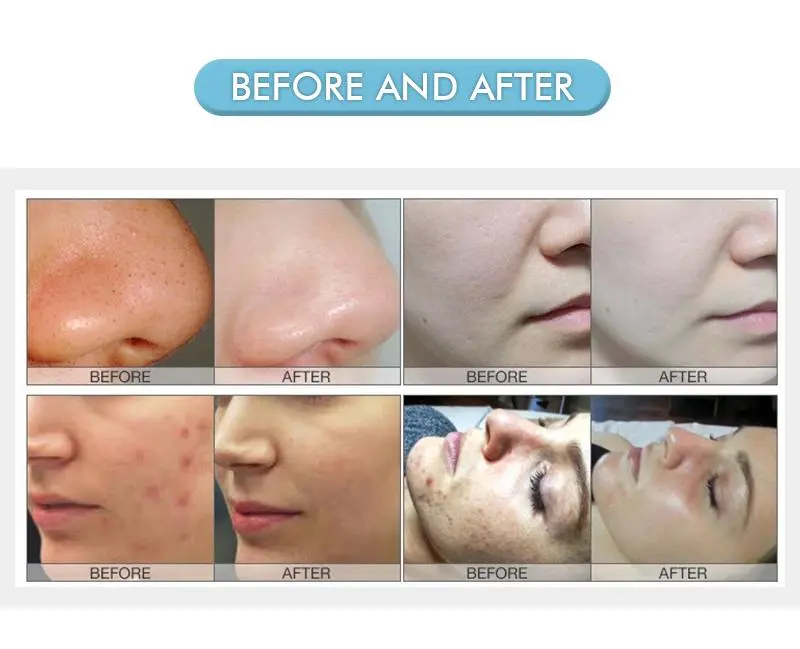 china hydro dermabrasion machine manufacturers china hydro dermabrasion machine manufacturers