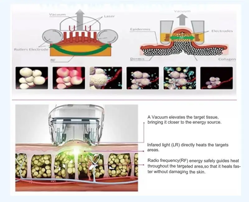 Velashape Slimming Machine made in China Velashape Slimming Machine made in China