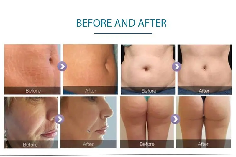 china Velashape Slimming Machine for sale china Velashape Slimming Machine for sale