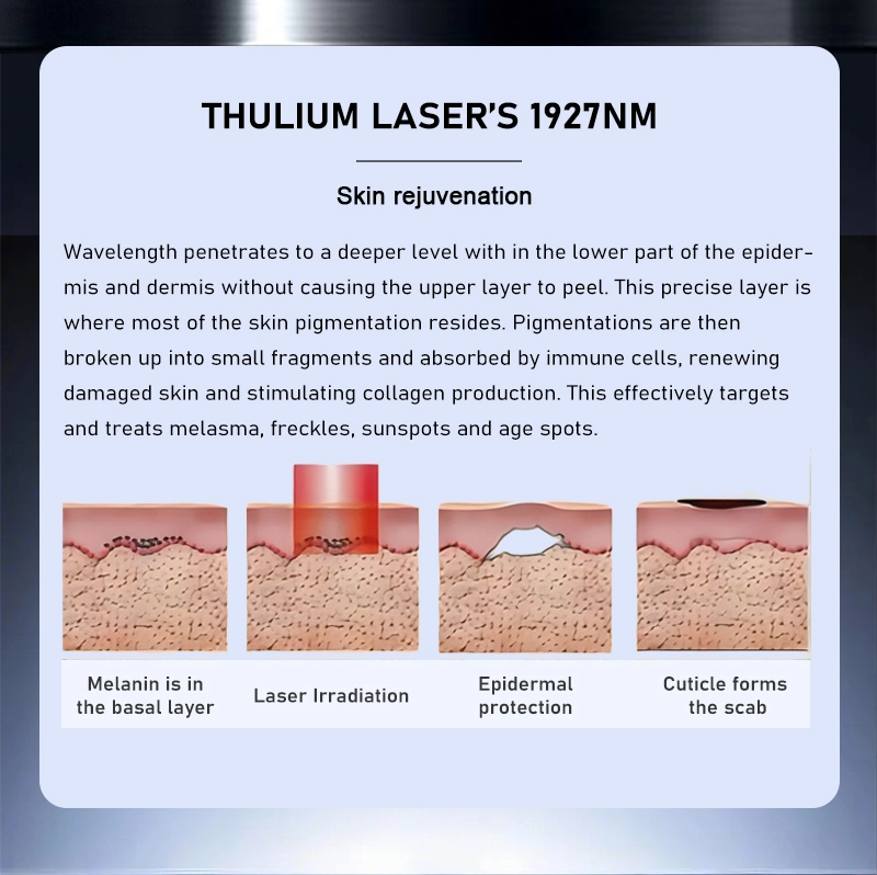 1927nm Fractional Thulium Laser 1927nm Fractional Thulium Laser