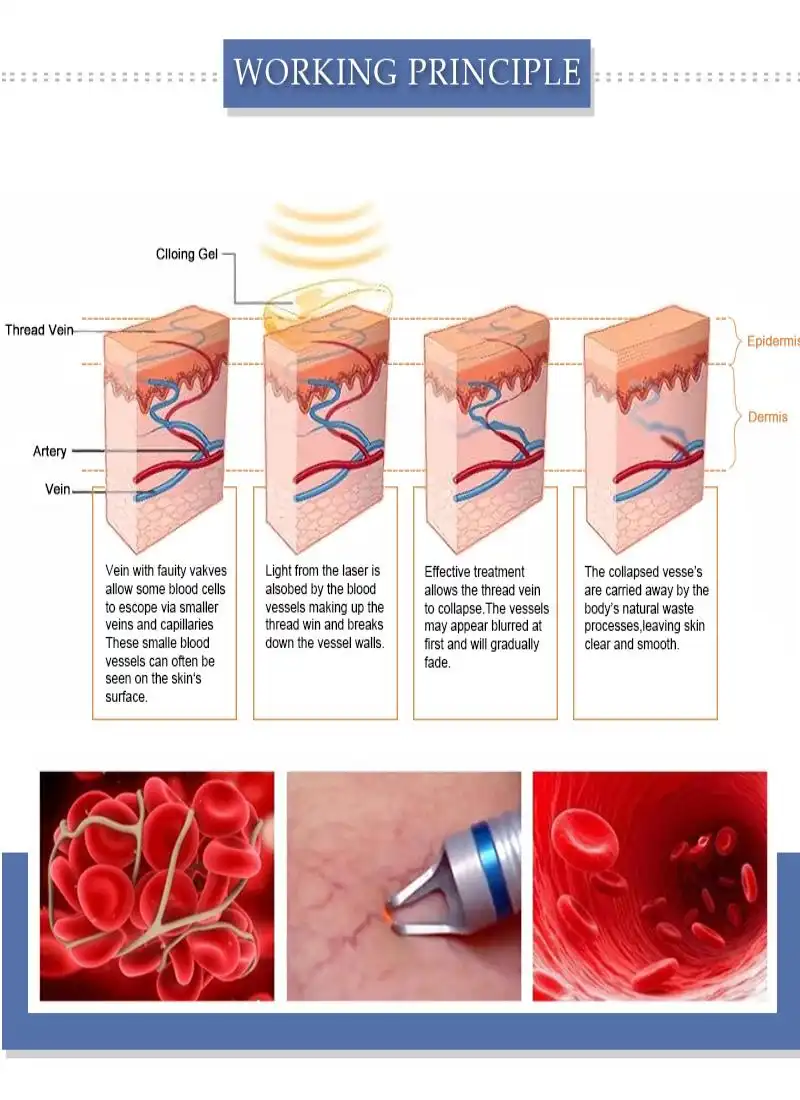 980 nm diode laser for vascular removal made in China