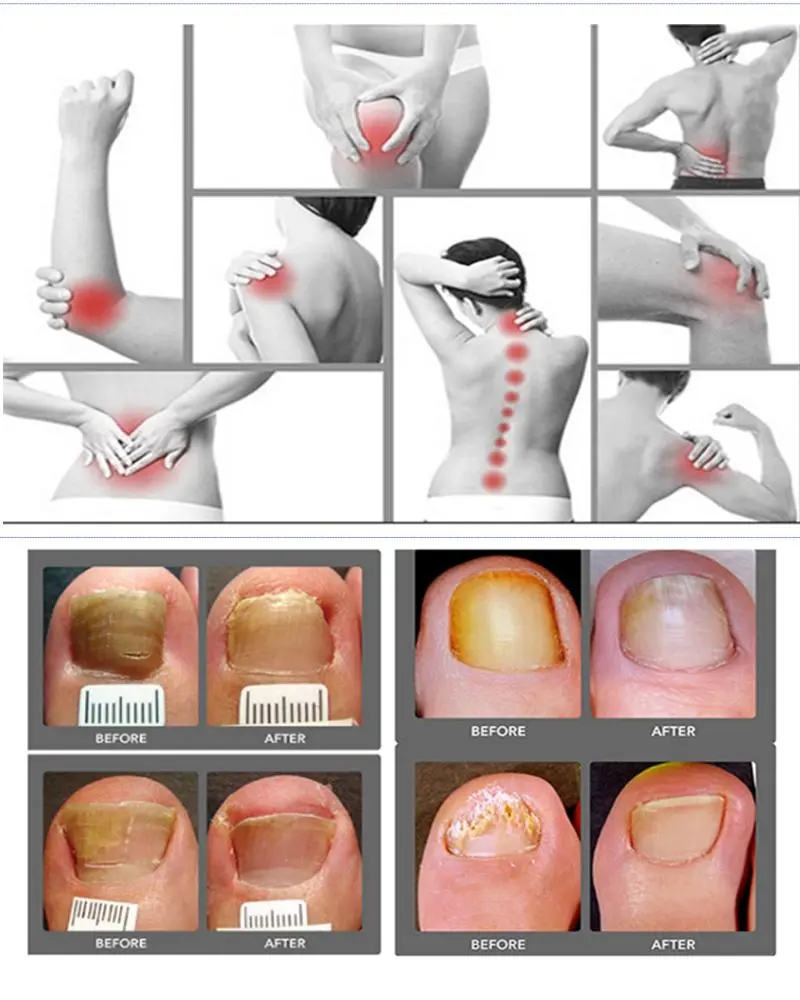 wholesale 980 nm diode laser spider vein removal machine