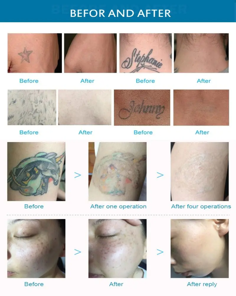 laser tattoo removal machine for sale  