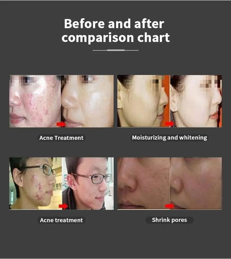 china pdt light therapy machine factory china pdt light therapy machine factory