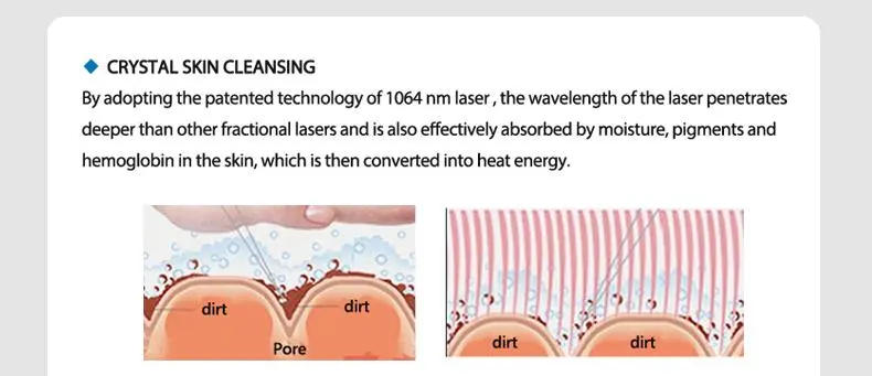 1064 nd yag laser hair removal for sale  