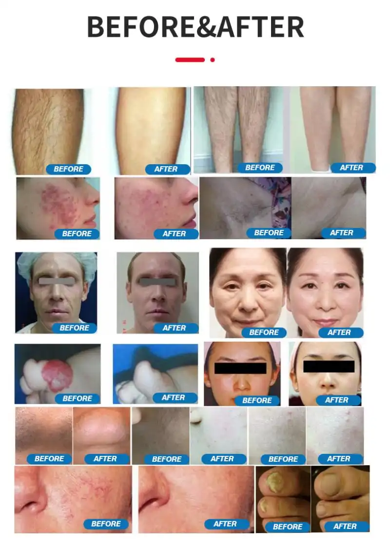 china 1064 nd yag laser hair removal 