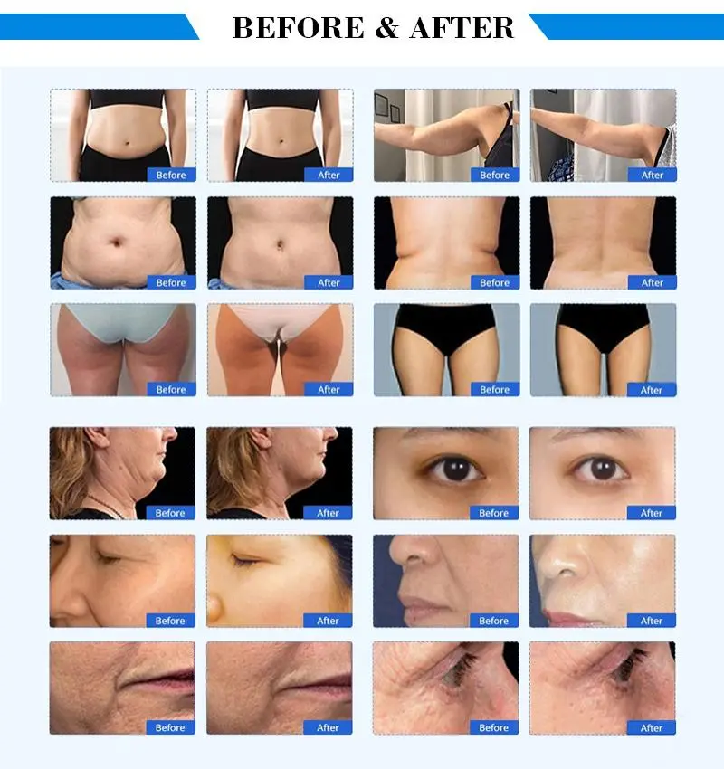 china 40k lipo cavitation machine for sale china 40k lipo cavitation machine for sale