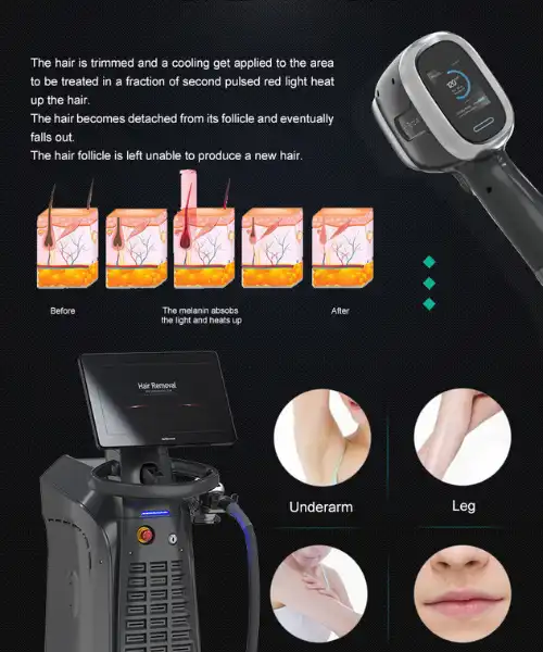 808 diode laser hair removal machine suppliers